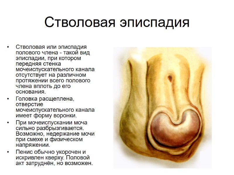 Стволовая эписпадия Стволовая или эписпадия полового члена - такой вид эписпадии, при котором передняя